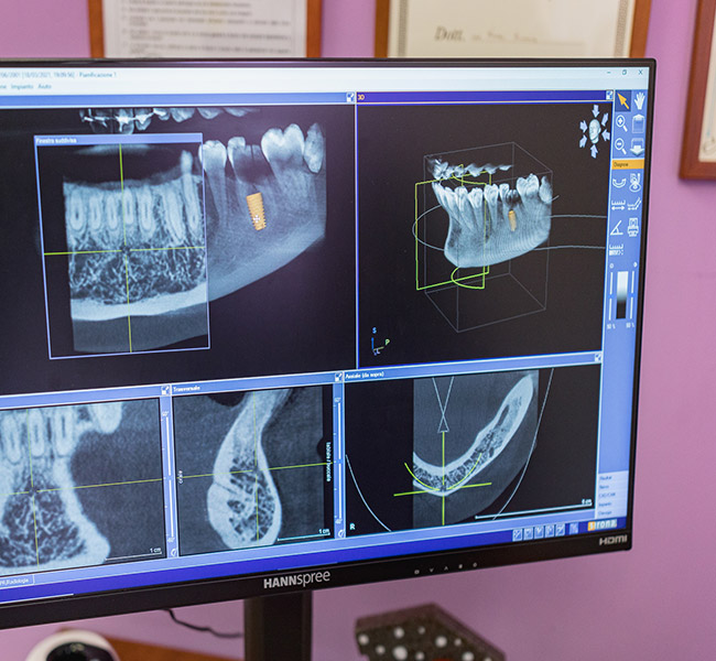 Tac Cone Beam, tecnica diagnostica di tomografia computerizzata- Studio dentistico Nicosia Palermo