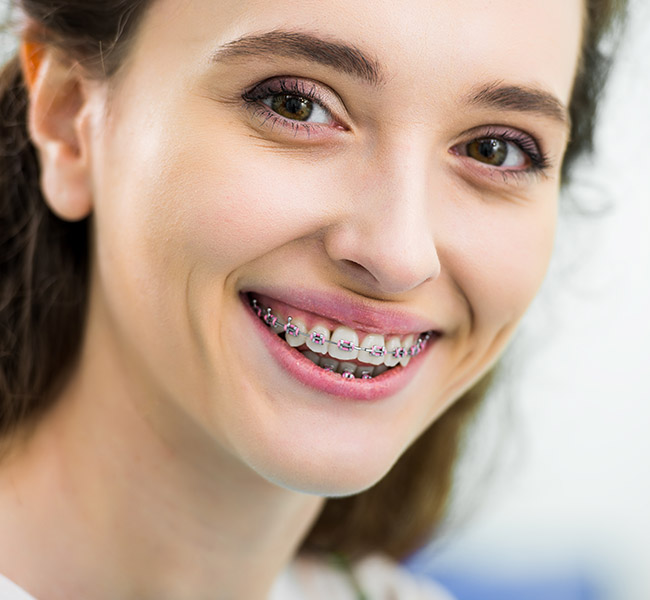 Ortodonzia fissa - trattamenti - Studio dentistico Nicosia Palermo